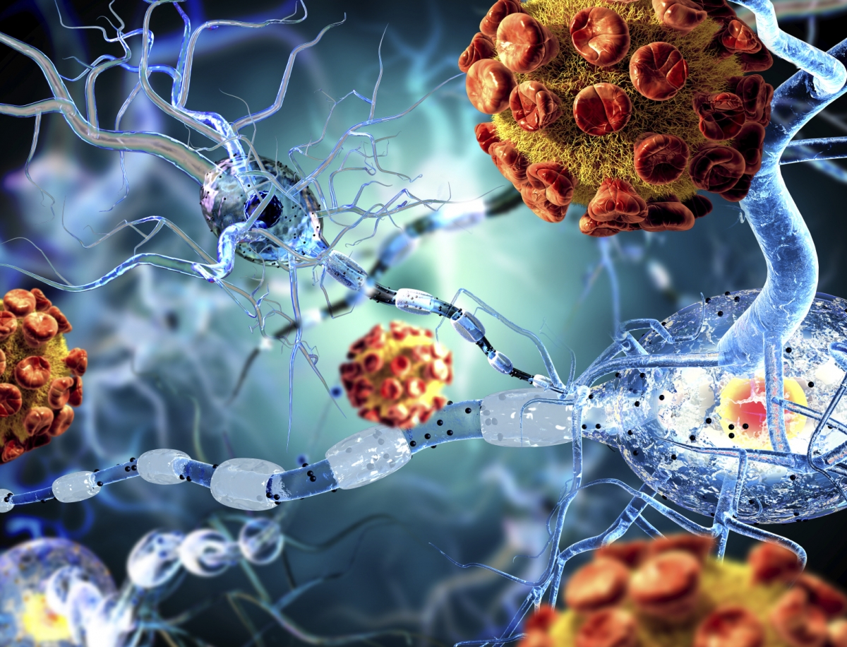 Saiba sobre Esclerose Múltipla e Doença de Parkinson