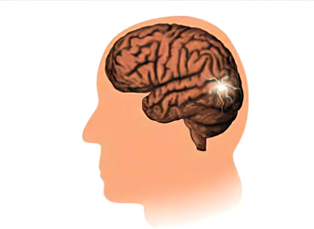 O que é convulsão focal segundo a Germânica Heilkunde?