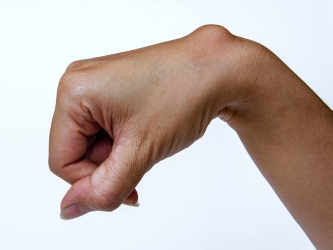 O que é um cisto sinovial (gangliônico)? Pela Germânica Heilkunde