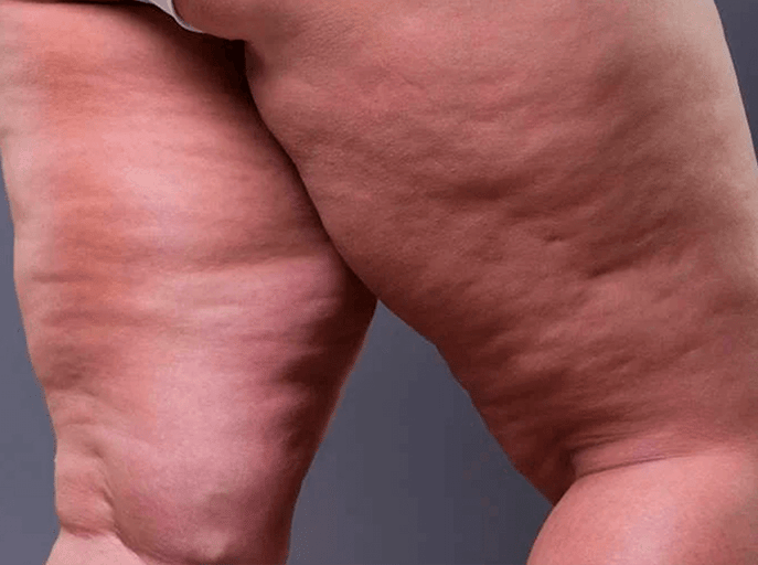 Celulite: Como eliminá-la segundo a Medicina Germânica