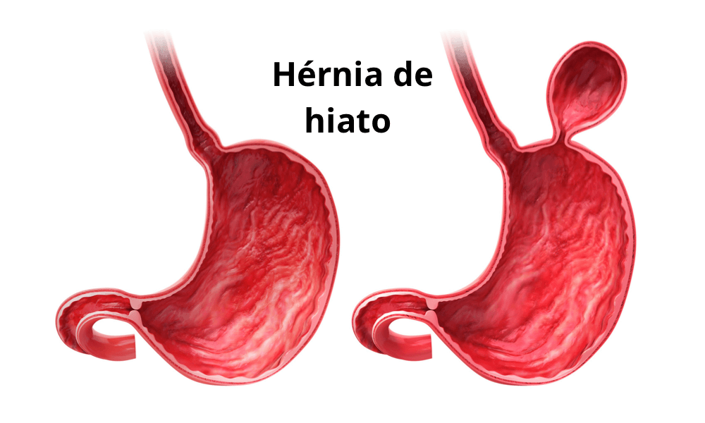 O que é hérnia de hiato? Pela Germânica Heilkunde