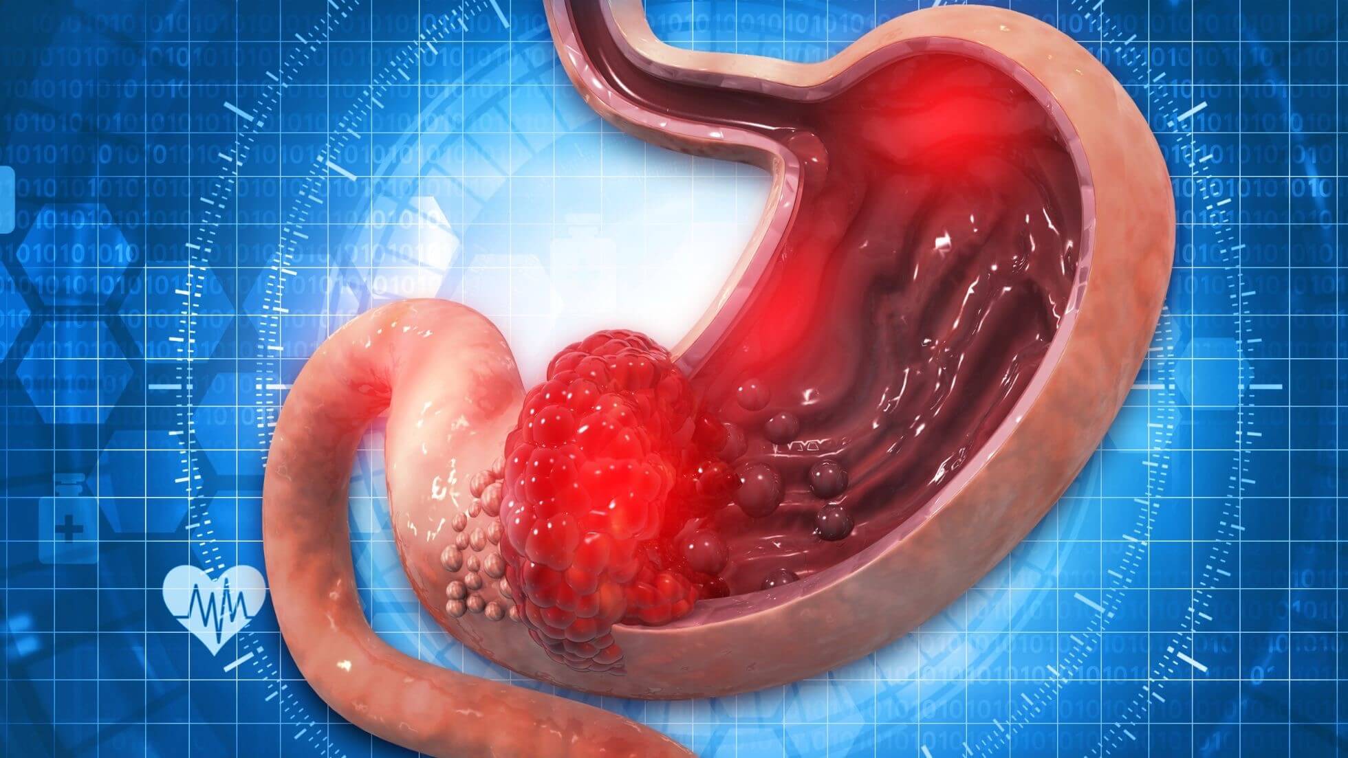 O que é úlcera péptica? Pela Germânica Heilkunde