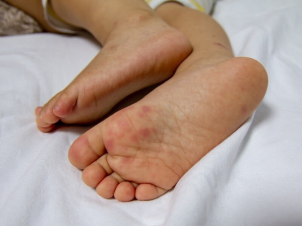 Doença mão-pé-boca pela Germânica Heilkunde