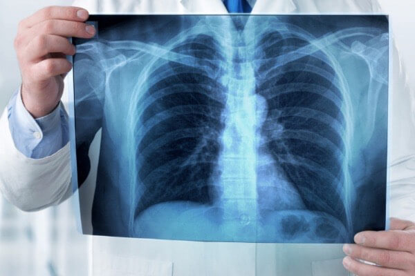 Cardiomegalia de acordo com a Germânica Heilkunde